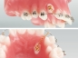Preview: Goldkette für retinierte Zähne