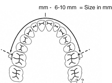 Molaren-Distalisierungs-Bogen, Größe 5 (92 mm)