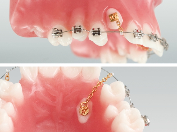 Goldkette für retinierte Zähne